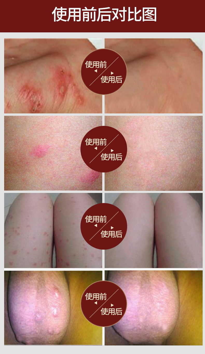 福堂疥清拓实疥清一号 疥去阴虱疮螨虫湿虱疥虫止痒 两盒巩固装【图片