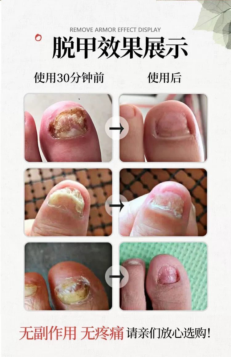 去灰指甲液发黑分离去除增厚灰甲脱甲膏喷剂专用液超大容量三盒装