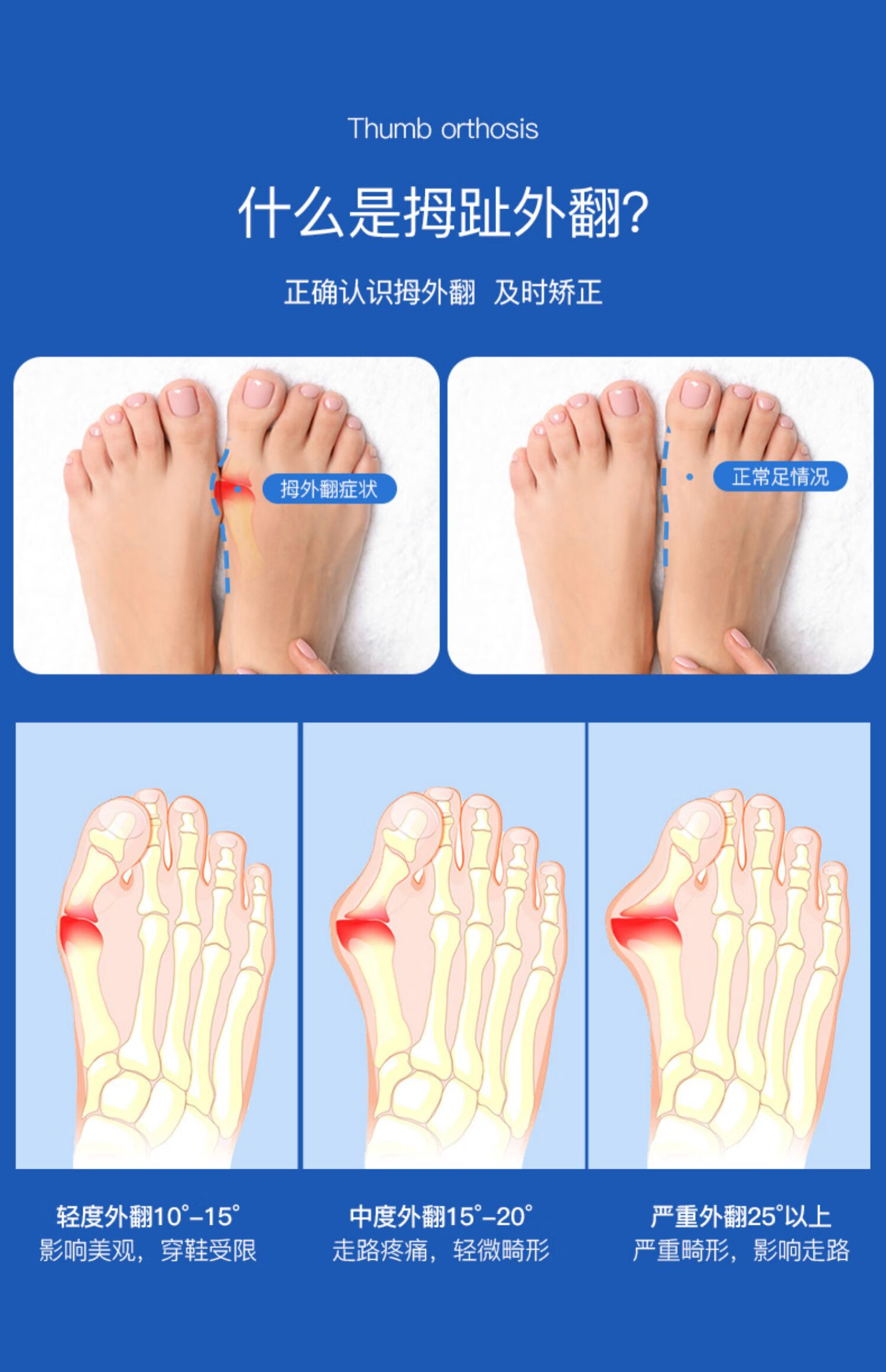 姆外翻腳趾矯正器大腳趾拇指外翻矯正器分趾器母指頭矯形可以穿鞋改善