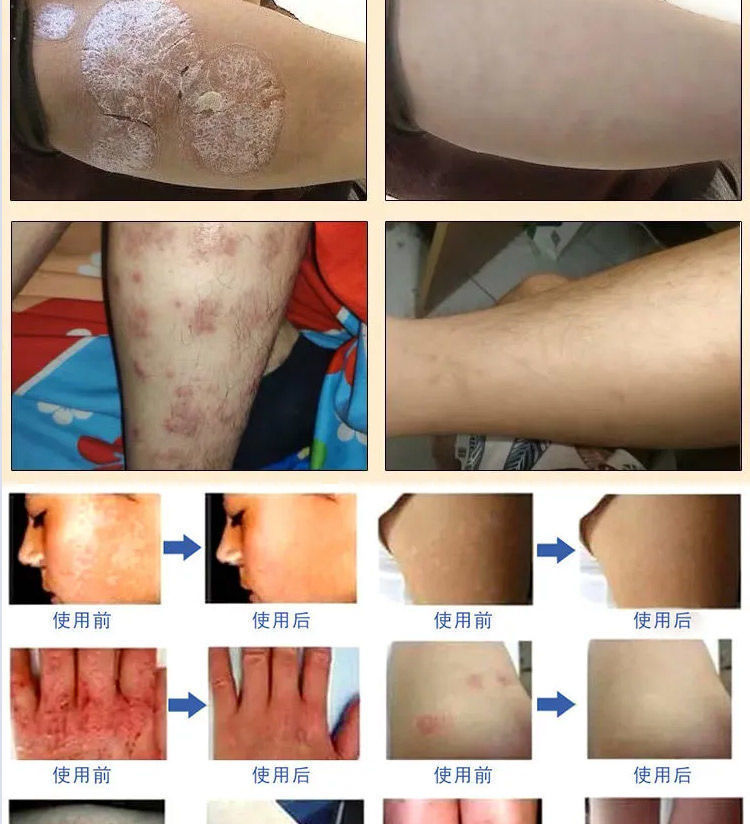 癣王顽达康苗疆五毒癣牛ii皮薬i膏癣藓病屑银外用薬止痒外用皮肤皮l廯