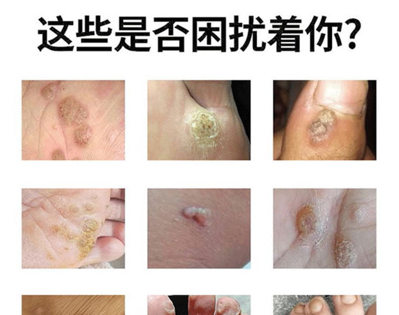 疣克舒软膏去面部扁平脸部疣脖子丝状优手足去除寻常尤去除膏跖尤净