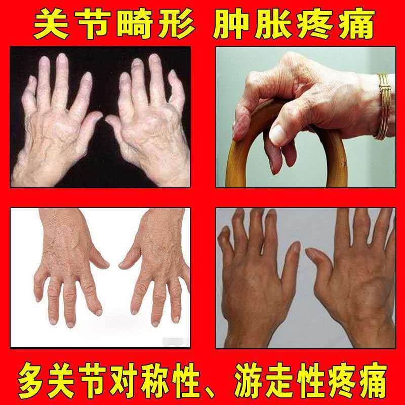 官方旗舰风湿类风湿喷剂指关节红肿关节变形手指肿痛足趾踝颞颌畸形