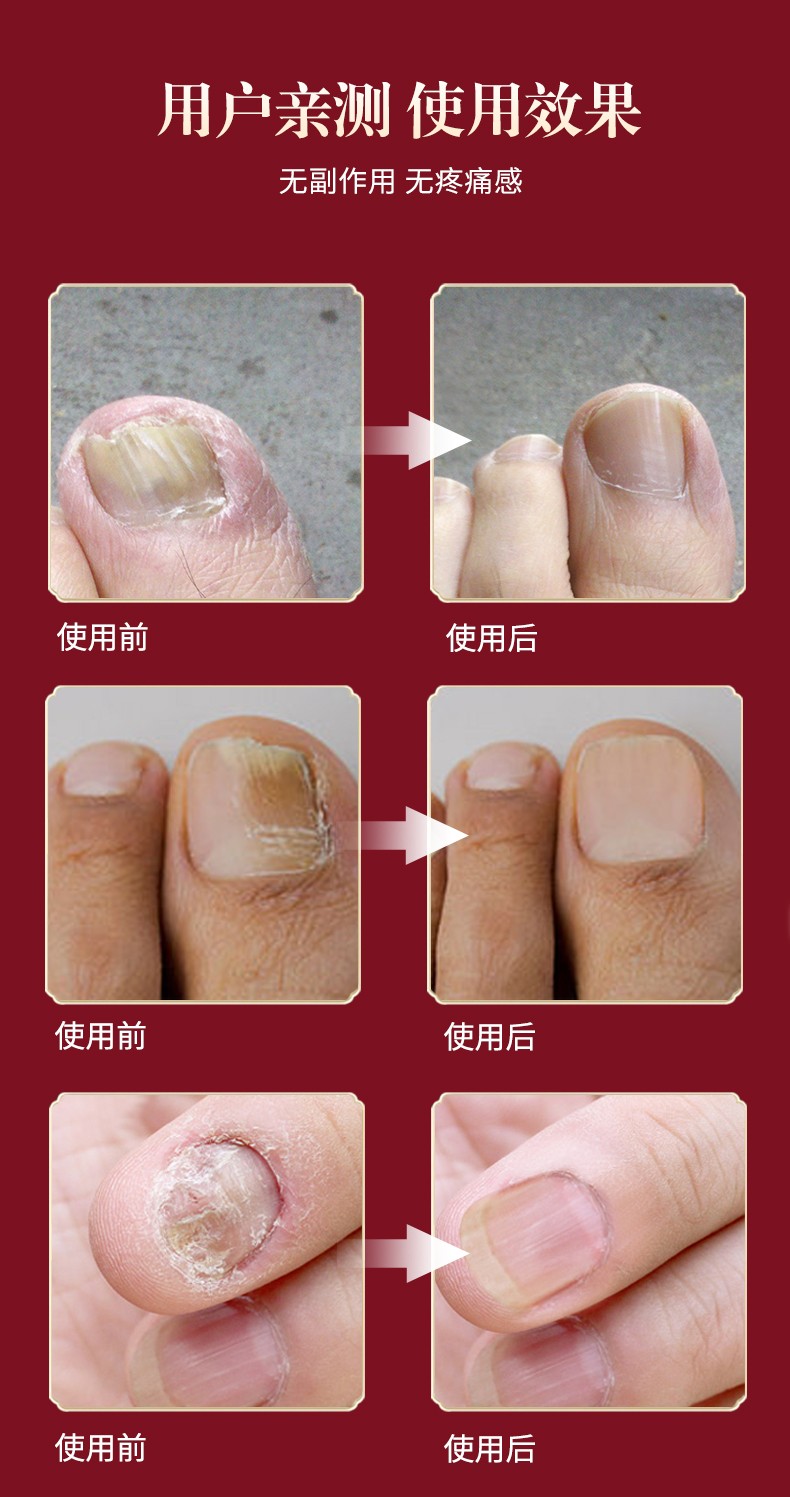 拯救灰指甲南方协和灰指甲特效甲沟专用盒抑菌液去除增厚发黄变空特效