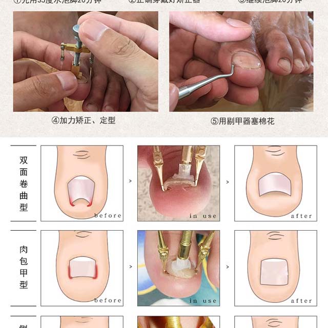 甲沟炎嵌甲修脚工具指甲矫正玫瑰金钳剔甲器无礼品