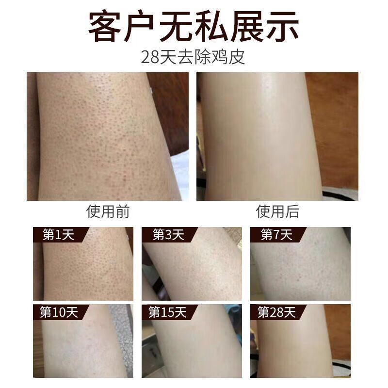 毛囊角化可以涂身体乳吗(毛周角化症可以涂身体乳吗) 毛囊角化可以涂身体乳吗(毛周角化症可以涂身体乳吗)