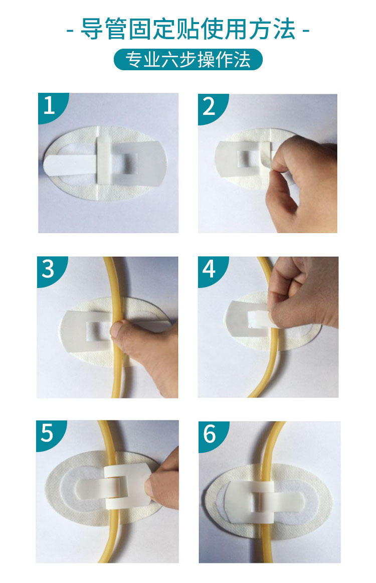 鼻饲管胶布的贴法图片图片