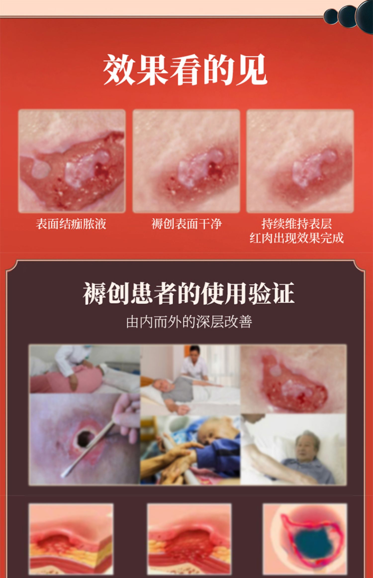 褥疮膏去腐生肌膏老人伤口愈合损伤修复老烂腿压疮贴外用黑色