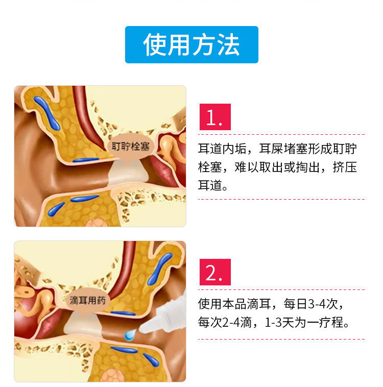 耵聍栓塞怎么治疗图片