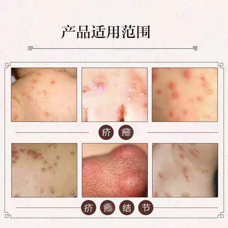 上海硫磺乳膏20含量硫磺软膏去螨虫疥虫虱虫一扫光皮