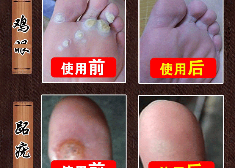 疣克舒软膏去面部扁平脸部疣脖子丝状优手足去除寻常尤去除膏跖尤净