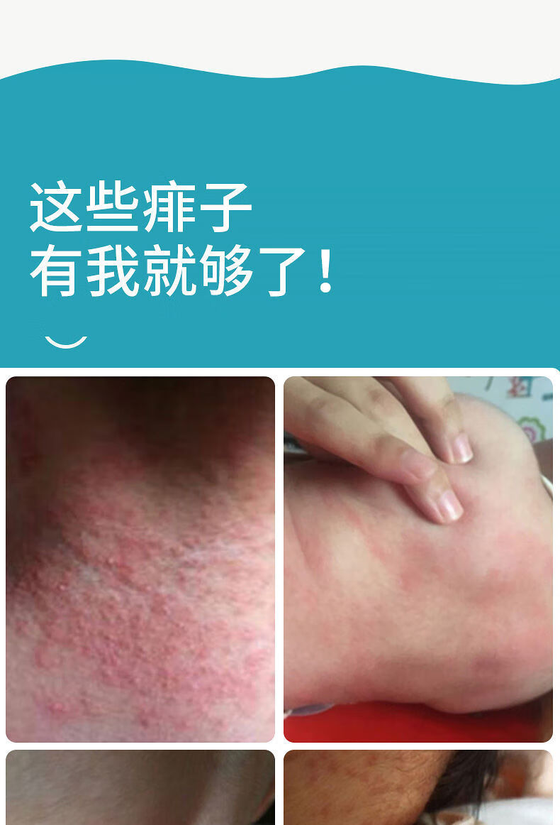 抖音同款宝宝痱子膏去痱止痒痱子粉新生儿婴儿专用热痱子霜儿童痱子水