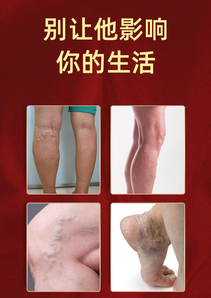 华北药业脉乐康凝胶可配静脉曲张贴成人老人小腿大腿部静脉血管青筋