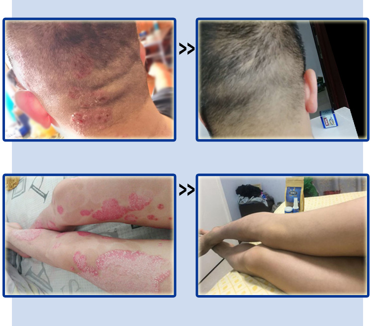 苗草癣外用苗草癣苗癣王草本乳膏紫椒癣百酊皮肤瘙痒止痒阴囊 1盒苗草