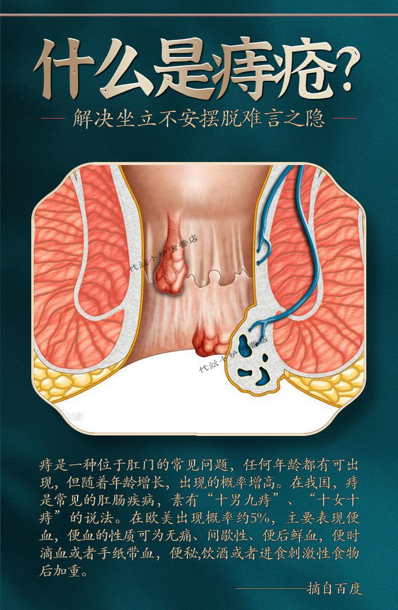 官网授权白云山痔c疮膏痔证品女性内外混c合痔肛周瘙痒发琰冷敷凝胶