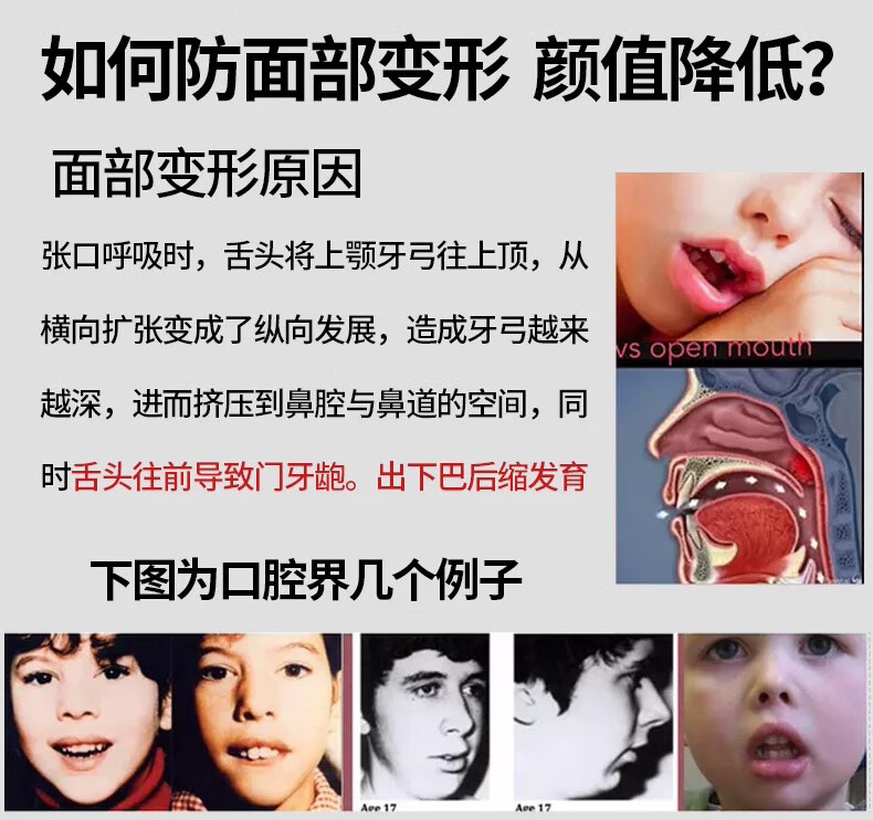 嘴唇矯正神器腺樣體肥大面容器嘴唇上翹器腺體肥大張口呼吸器嘴巴粉紅