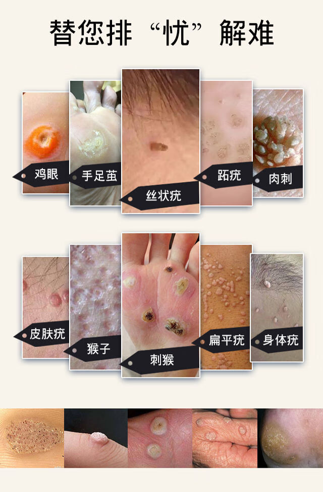 疣瘊肉粒一抹无忧加丹一号去脖子疙瘩扁平丝状尤鸡茧猴子1盒15ml