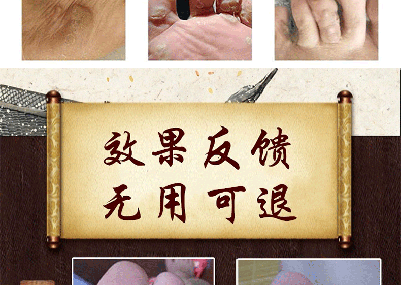 疣克舒软膏去面部扁平脸部疣脖子丝状优手足去除寻常尤去除膏跖尤净