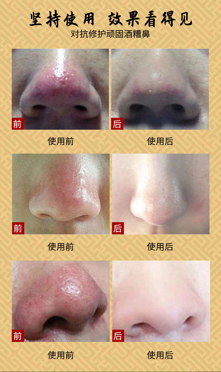 去酒糟鼻红鼻子草莓鼻修复鼻部红血丝红鼻头酒渣鼻毛孔男女发一盒轻度