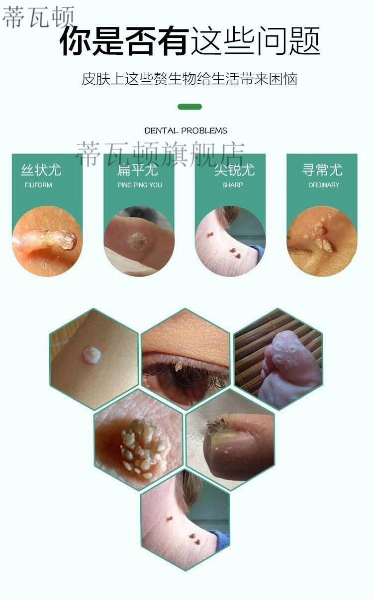 疣瘊净液去猴子疣刺祛丝状尤去除脖子小肉粒去神器颈部赘皮 京胜5盒