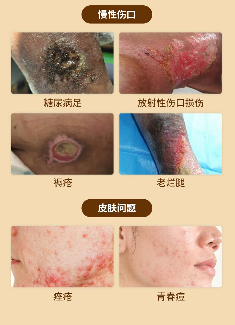 伤口剖腹产化脓感染手术愈合敷料促进长肉外伤口糖尿病足褥疮膏专用术