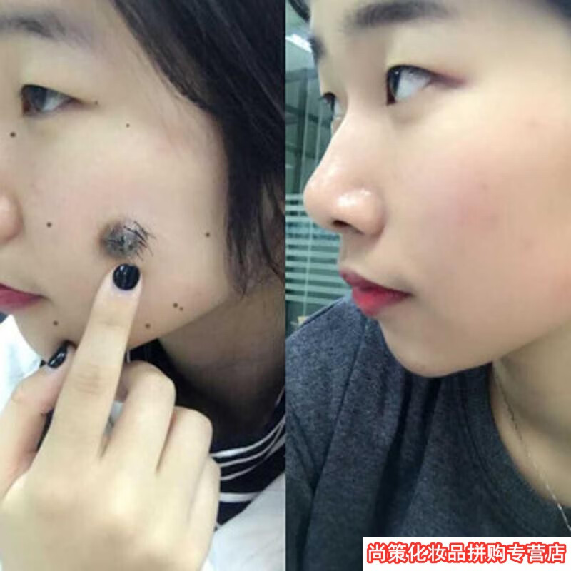 去痣点痣药水无痕点痣膏祛痣黑痣痦子去