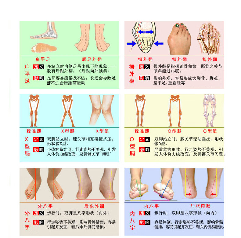 o型腿矫正鞋垫o形腿矫正带儿童足内翻内外八字脚男女美腿3537黑色其它