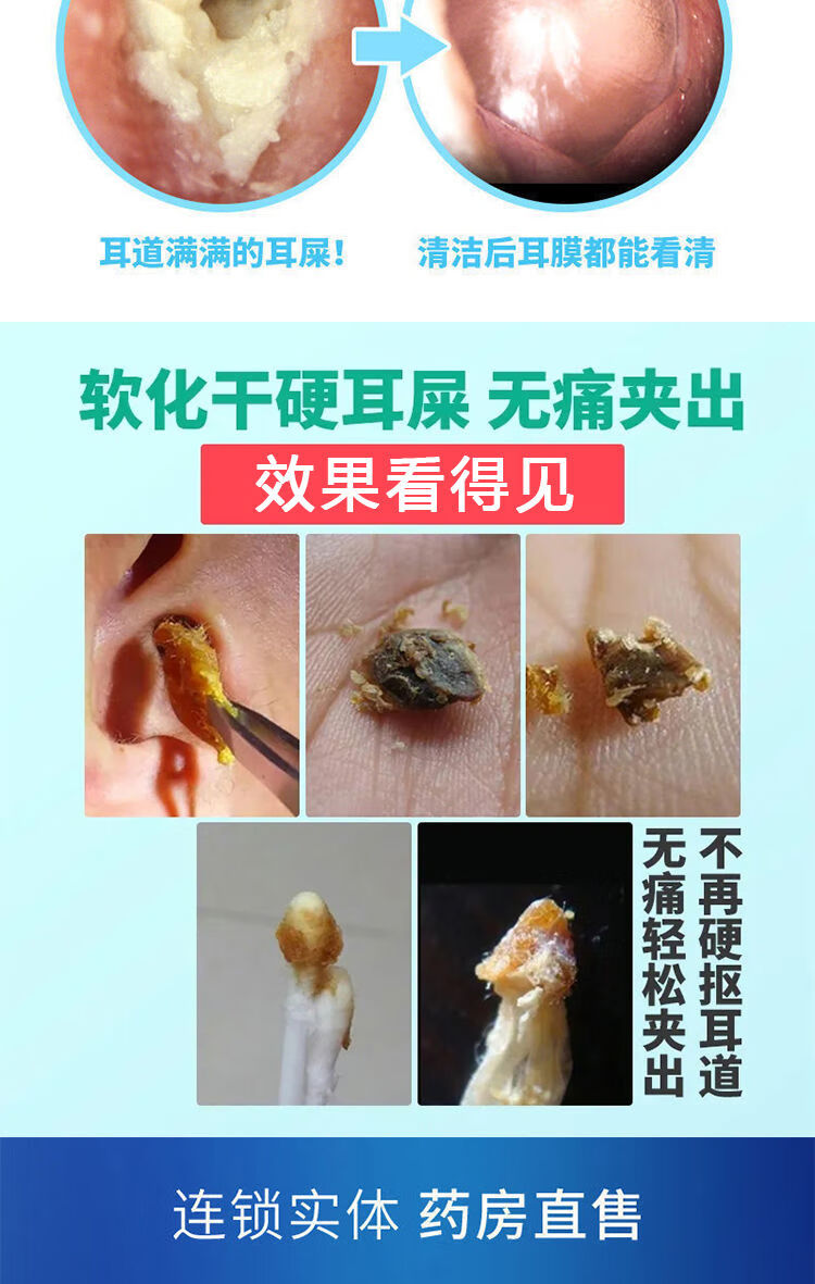 耳垢软化滴l耳l液人用 耳道清洁洗耳液滴l耳l油 耵聍水耳结石耳屎软化