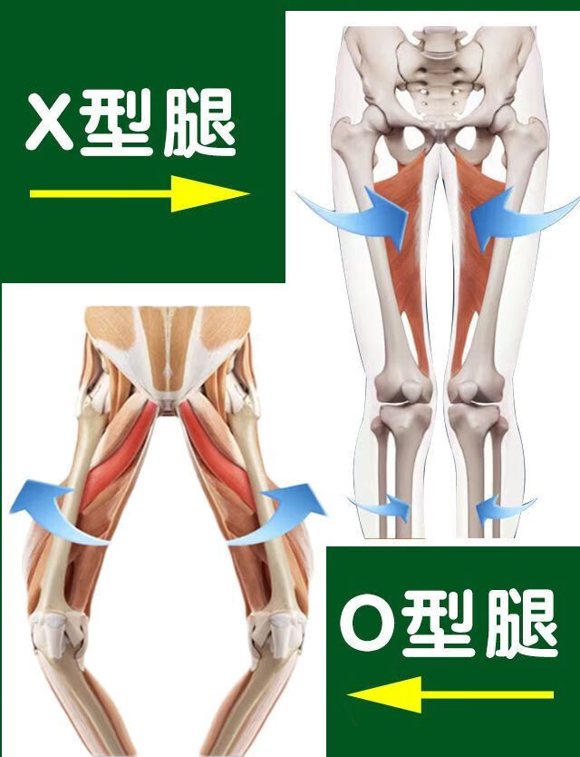 o型腿型小腿外翻羅圈腿x型腿器成人兒童改善