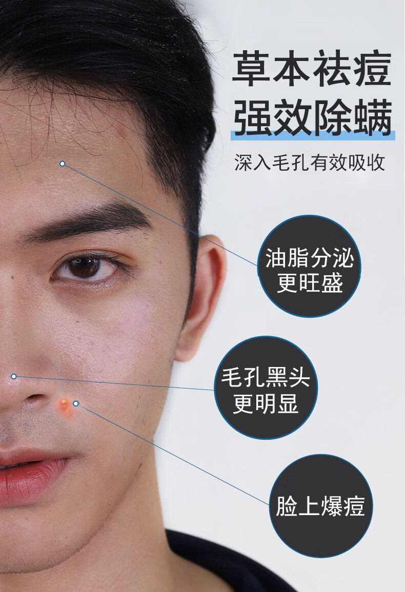 伟博优肤堂膏痘立净精华液紫草印痘坑青春痘闭口粉刺女男惊喜推荐款
