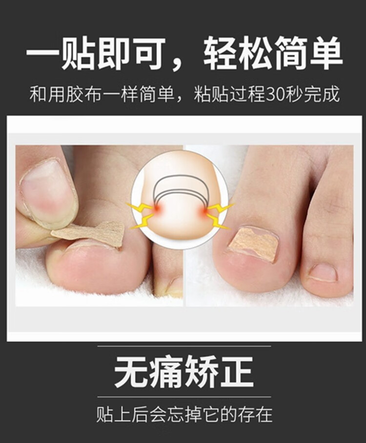 新品精选正甲贴甲沟炎矫正贴嵌甲脚趾甲纠正指甲贴片长肉里修正甲神器