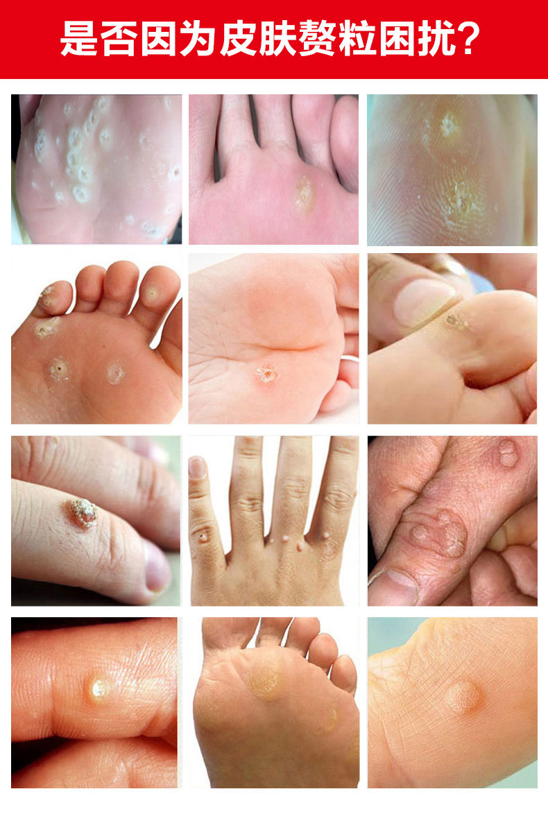 诗莱格膏去i除水猴子脚趾跖i疣脚底手部足部专用老茧肉i刺男女通用三