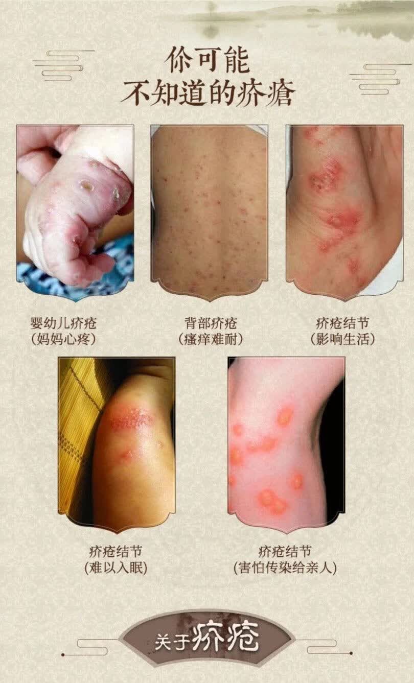 25%苄酯乳剂虱子螨虫疥虫头螨剪发虫除螨剂送止痒膏疥疮膏 卞酯原液不
