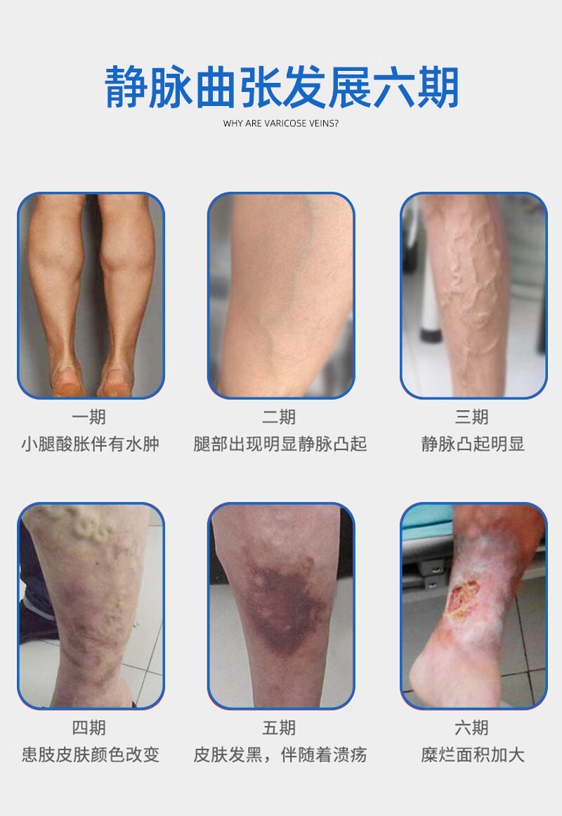 蔚蓝医药静脉曲张贴膏可配静脉曲张喷剂精索腿部肿胀血管凸起蚯蚓腿