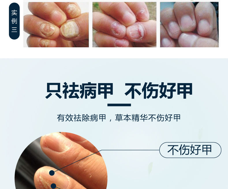 软函甲康灵软涵函甲乐康灵小白盒官方灰指趾甲冷敷凝胶修护液套一盒装