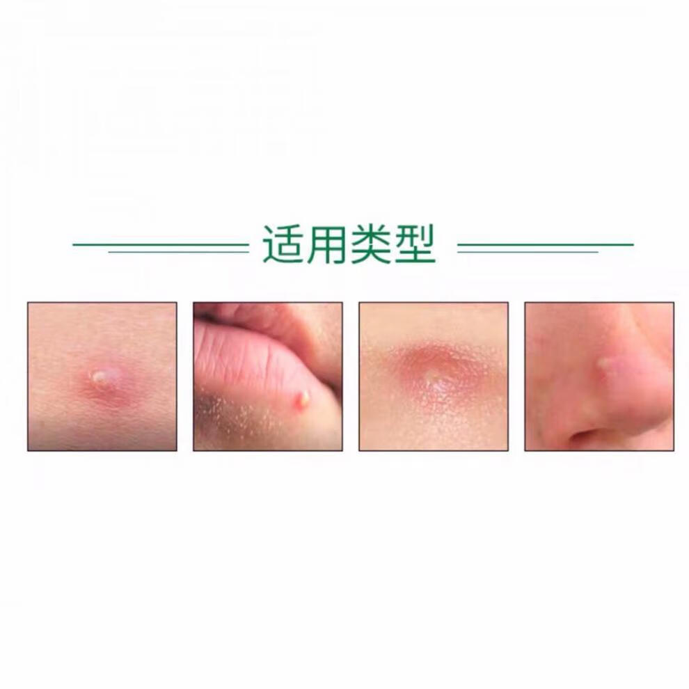 mariobadescu净痘精华液温和祛痘去粉刺闭精华水杨酸祛红肿爆痘29ml1