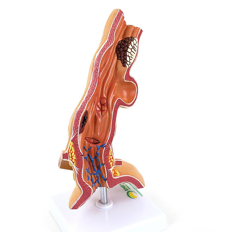 人体食管疾病理模型 医院消化科教学医患沟通人体解剖模型食管模型