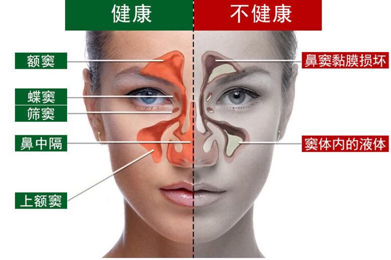 鼻子通气膏苗药中性鼻塞鼻痒鼻窦鼻息干燥不通气流鼻涕打喷嚏濞通膏鼻