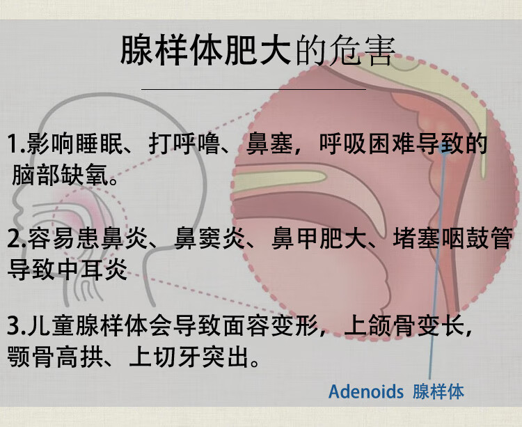 咽炎貼咽急慢性喉嚨有痰異物感腫痛扁桃體發炎兒童腺樣體肥大三盒s