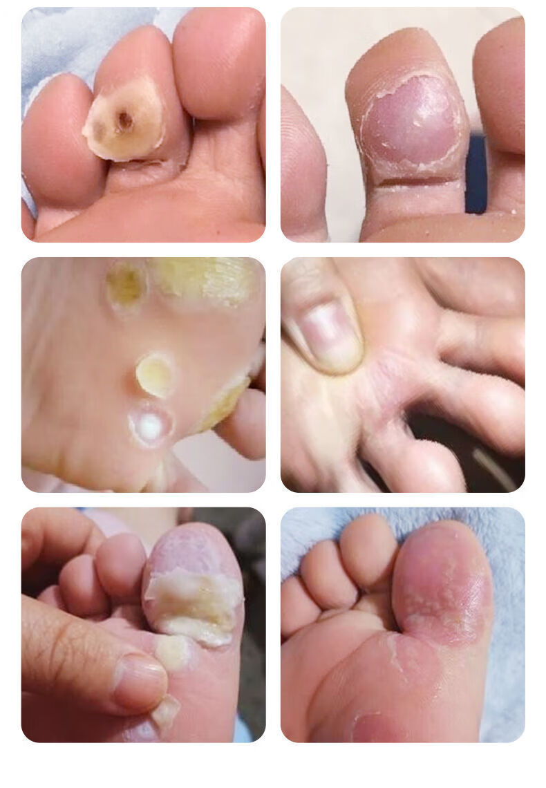 12贴鸡眼贴专用非药鸡眼膏贴老茧瘊子脚底脚趾疣肉刺瘊手足尤gh 一盒