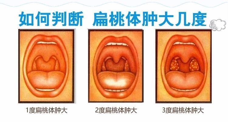 钩突肥大的图片图片