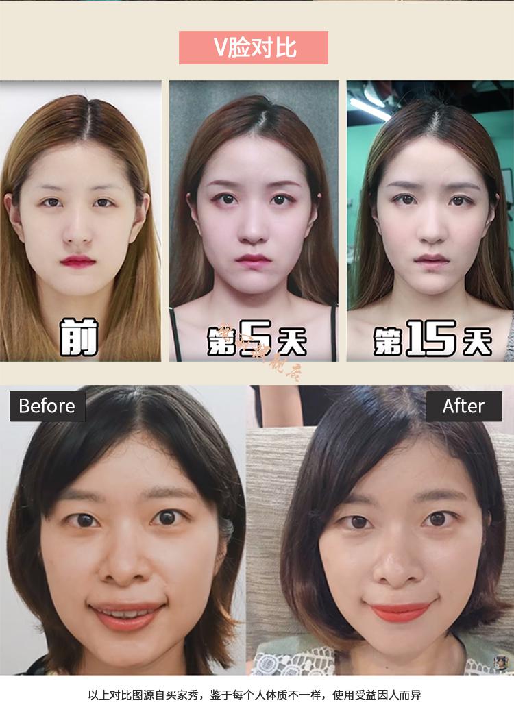 耐辉顿 改善法令纹消除器小v脸改善去法令纹面部提拉紧致神器提升脸部