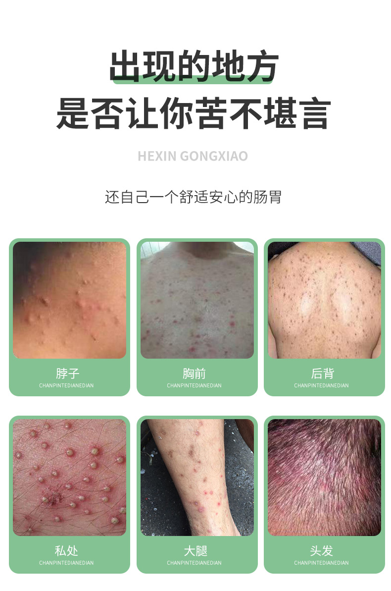 赞克阿赞多c型中草本膏官方链接专攻毛囊痘啊赞多c型中重度两盒装