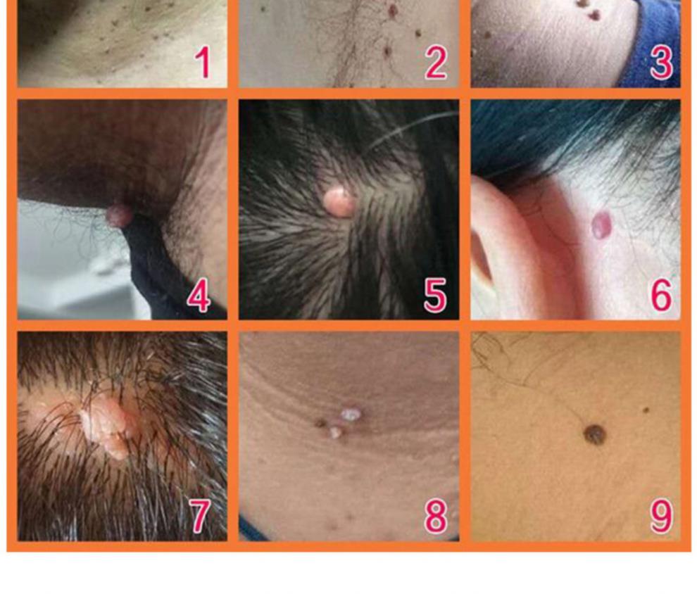 2022新款激光去疣 去疣脂肪粒眼部神器汗管瘤丝状疣肉粒扁平快速去除