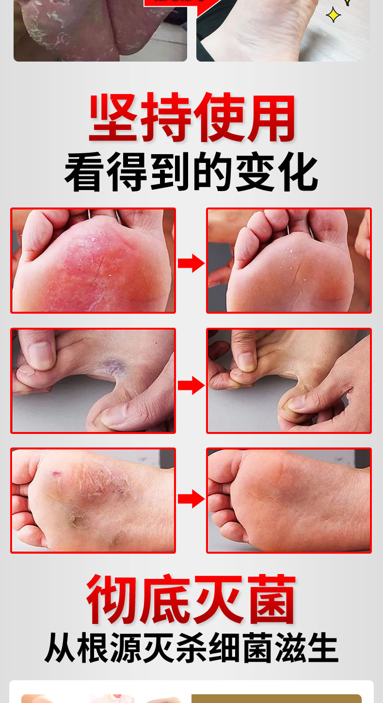 脚气王烂l脚丫脚痒水泡治脚汗干燥开裂脱皮糜烂止痒去l脚臭l克星喷雾