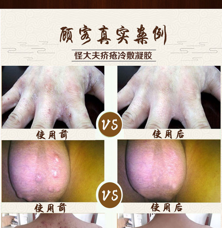 怪大夫疥i疮膏疥i疮结节疥虫阴虱去螨虫阴囊止痒膏皮肤瘙痒软膏 买5 2