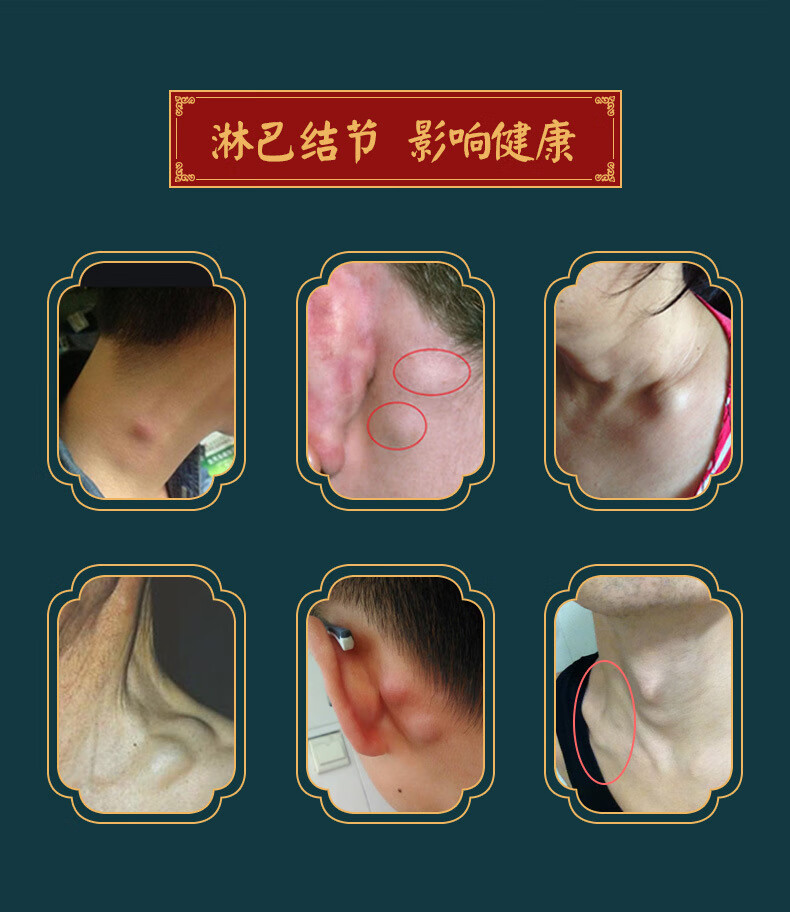 【官方】淋巴散结通络膏腋窝收腋下肿大疏通淋巴结节散结膏肿大淋巴结