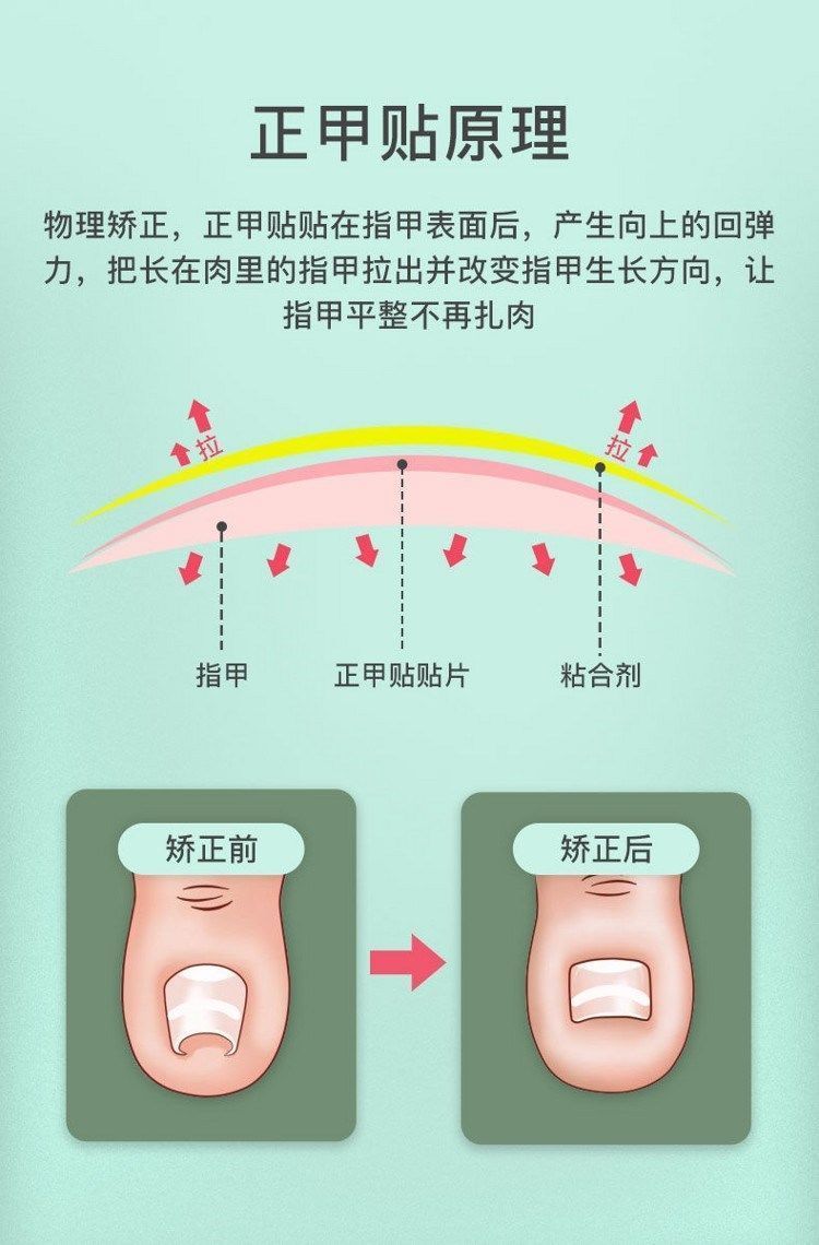 正甲贴甲沟炎神器嵌甲指甲矫正器脚趾甲长肉里免胶水拉拉纠正贴片免