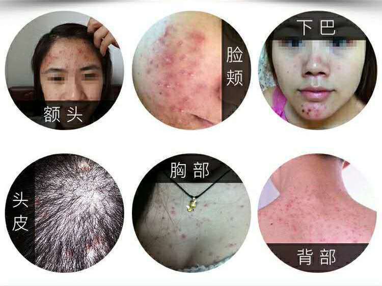 治马拉色菌毛囊炎的药膏头皮炎湿疹胸前背部脓包痤疮痘痘疙瘩止痒 单