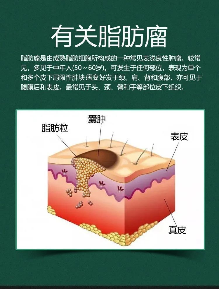 脂肪瘤消贴皮下脂肪瘤多发性单发性硬块脂肪粒消贴 1盒6贴装 一盒6贴