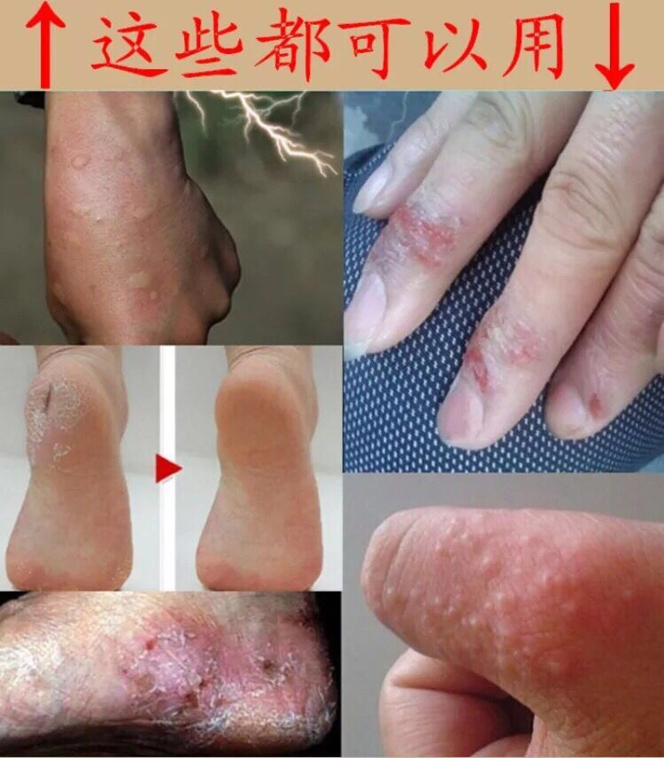 藥房直售 康夫康 手癬手足癬手蘚鵝掌風汗皰疹溼疹止癢去根乾裂脫皮